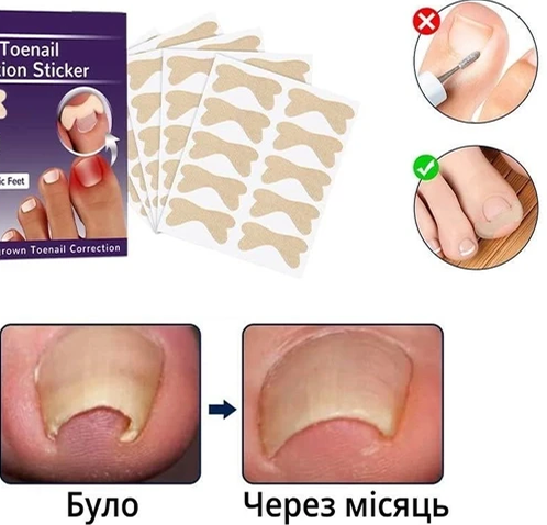 Результат використання пластирів Elastic Toenail Correction Sticker